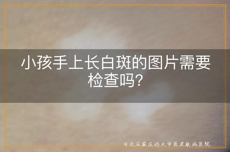 小孩白斑,白癜风,白色糠疹,花斑癣,贫血痣,营养不良,及时检查,科学治疗
