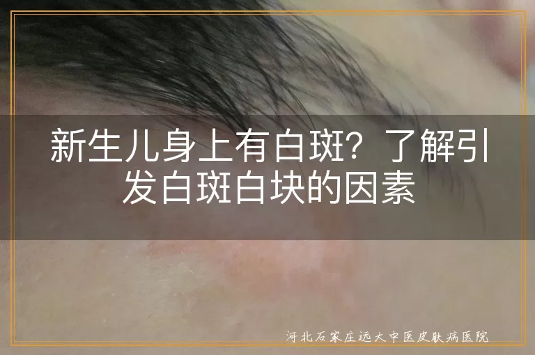 新生儿,白斑,胎脂,先天性疾病,白癜风,营养不良,微量元素缺乏,皮肤炎症,感染,环境因素