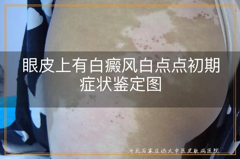 白癜风,眼皮,色素减退斑,初期症状,及早就医,专业检查,治疗方案