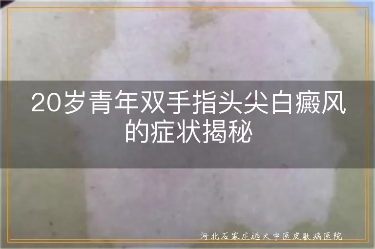 白癜风,20岁青年,双手指头尖,白斑,症状,治疗,防晒,心态