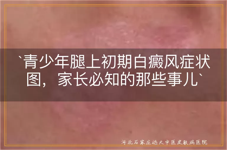青少年,腿上,初期白癜风,症状图,家长,正规渠道,及时就医