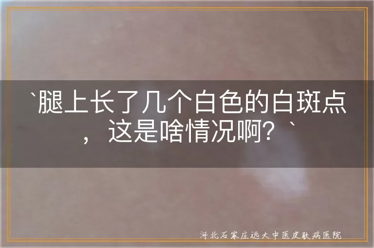 腿上白斑点,色素减退斑,特发性点状白斑,白癜风,贫血痣,预防,治疗