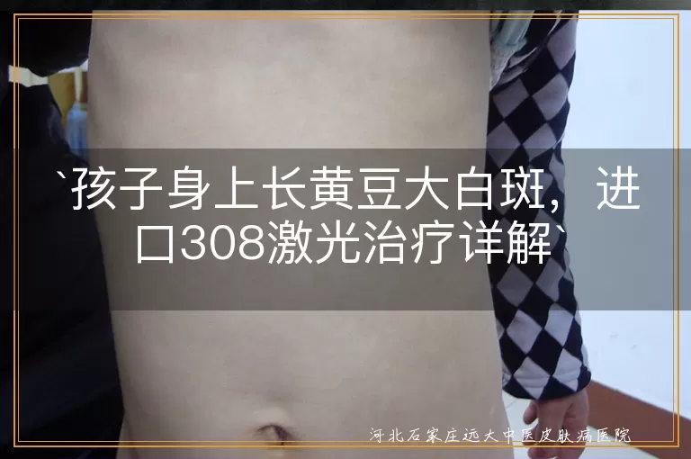 308激光,白斑,白癜风,治疗,安全,见效快,防晒,复查