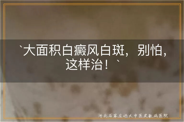 白癜风,白斑,治疗,药物治疗,光疗,激光治疗,手术治疗,注意事项