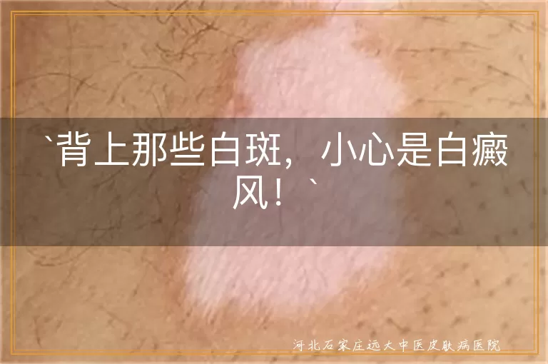背上白斑,白癜风,色素脱失,早治疗,预防