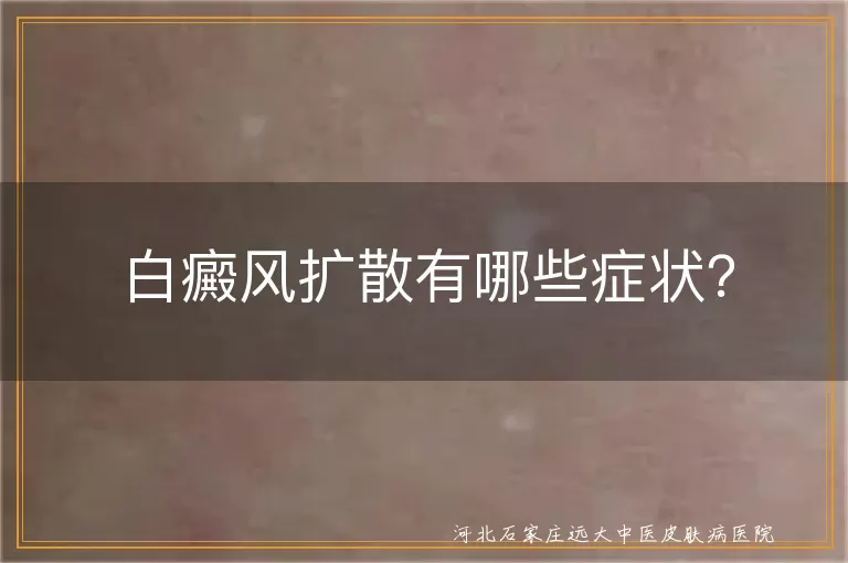 白癜风,扩散,白斑,瘙痒,疼痛,红肿,脱发,治疗,营养补充