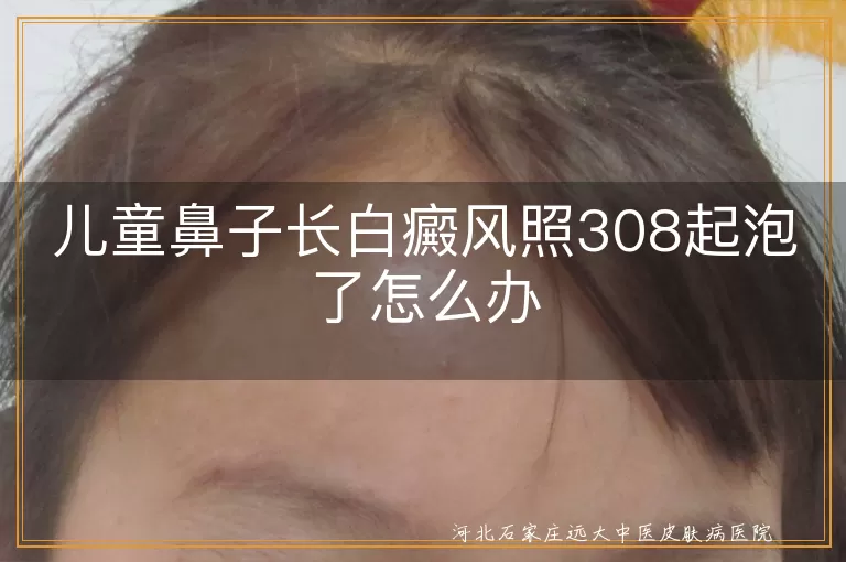 儿童白癜风,308激光治疗,起泡,护理,医生建议,日常护理,防晒,均衡饮食,心理疏导