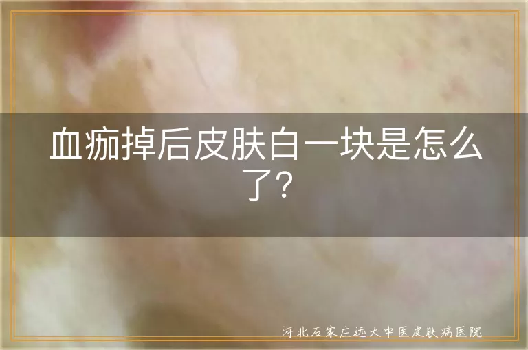血痂脱落,皮肤变白,伤口愈合,新生皮肤,色素细胞,日常护理,异常情况,就医