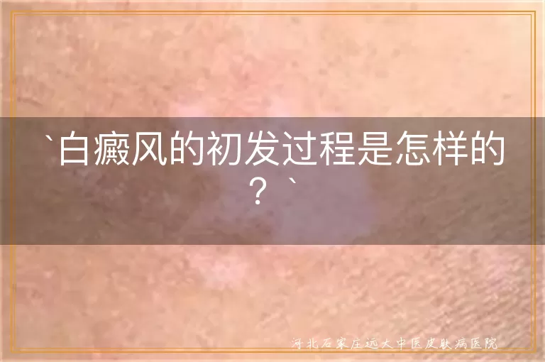 白癜风,初发过程,小白斑,逐渐扩大,数量增多,融合成片,正规医院,治疗