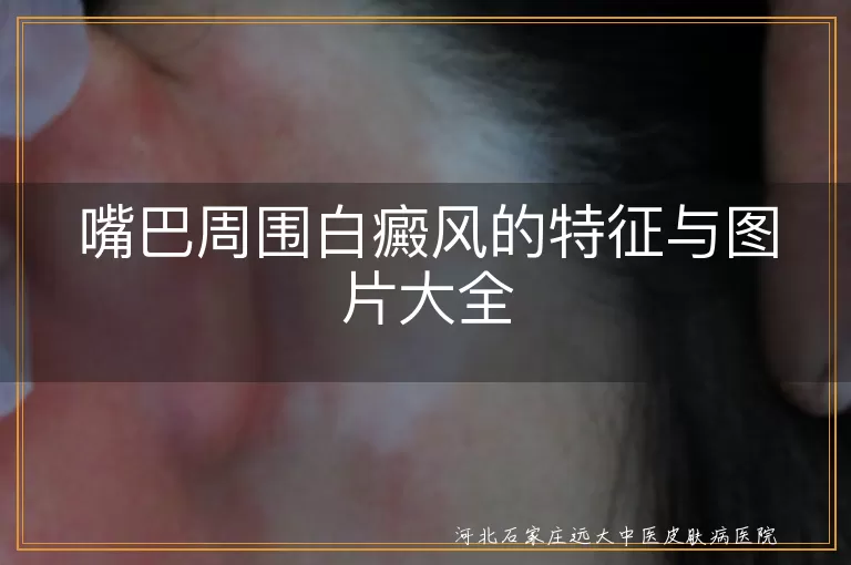 嘴巴周围白癜风,白斑,瘙痒,湿疹样变,治疗,生活习惯