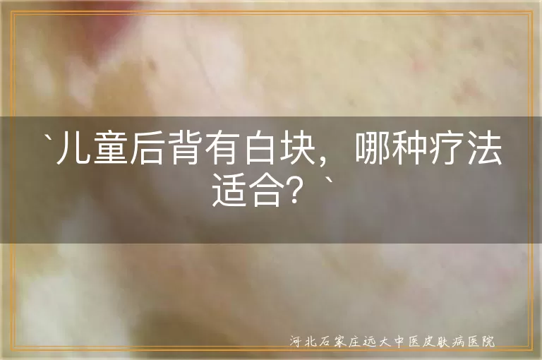 儿童后背白块,白癜风,白色糠疹,花斑糠疹,治疗方法,饮食均衡,皮肤保湿,抗真菌药物