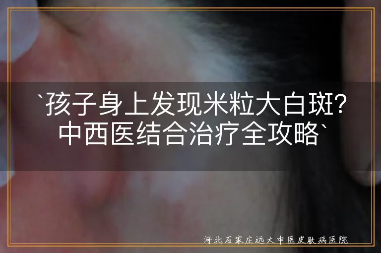 中西医结合治疗,白斑病,白癜风,儿童,激光治疗,光动力疗法,中药内服,中药外敷