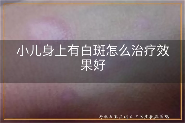 小儿白斑,白癜风,微量元素缺乏,光疗,手术治疗,心理治疗,日常护理