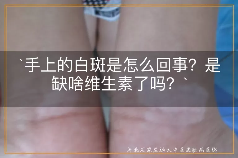 手上白斑,缺维生素,色素减退斑,白癜风,贫血痣,皮肤病,饮食均衡,及时就医