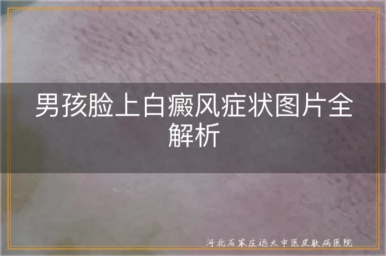 男孩,白癜风,症状,图片,诊断,治疗,心理关怀,日常护理