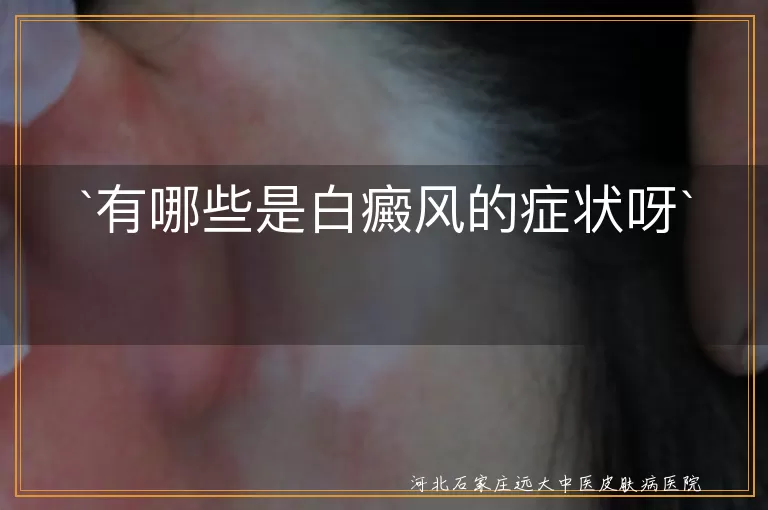 白癜风,白斑,皮肤干燥,脱屑,毛发变白,心理影响