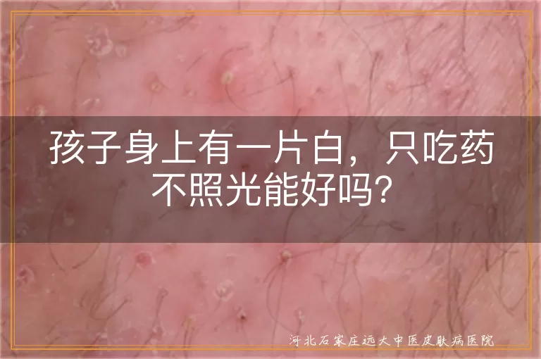 白斑,白癜风,药物治疗,光疗,极速308nm准分子激光,综合治疗,日常护理