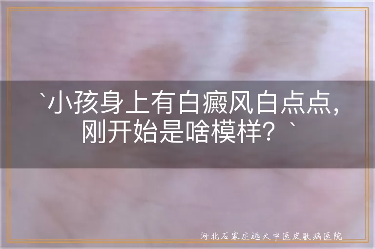 小孩,白癜风,白点点,初期症状,细心观察,及时治疗,综合治疗,耐心,信心