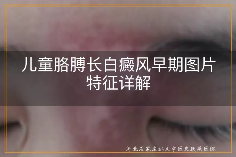 儿童白癜风,胳膊,早期症状,色素减退,治疗方法