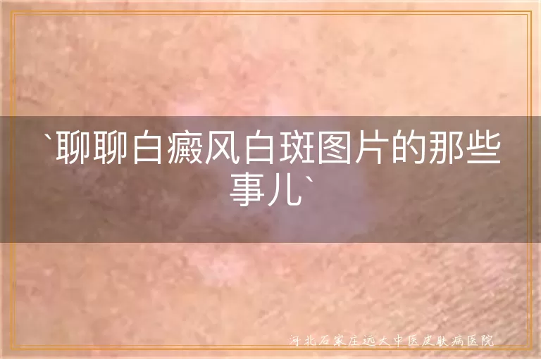 白癜风,白斑,图片,皮肤问题,心理影响