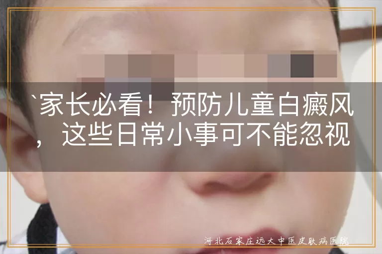 家长必看！预防儿童白癜风，这些日常小事可不能忽视