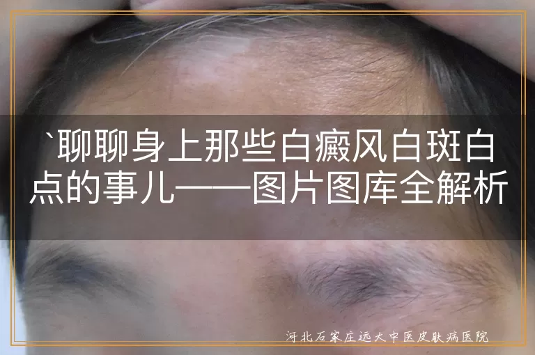 白癜风,白斑,白点,图片图库,初期症状,扩散期,稳定期,皮肤健康