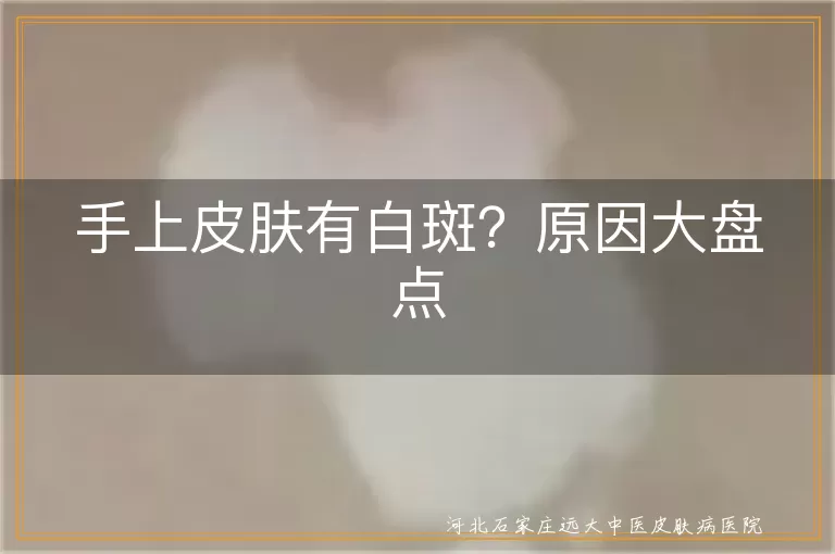 手上白斑,遗传,紫外线,皮肤炎症,营养缺乏,年龄增长,白癜风,花斑癣,无色素痣,预防,治疗