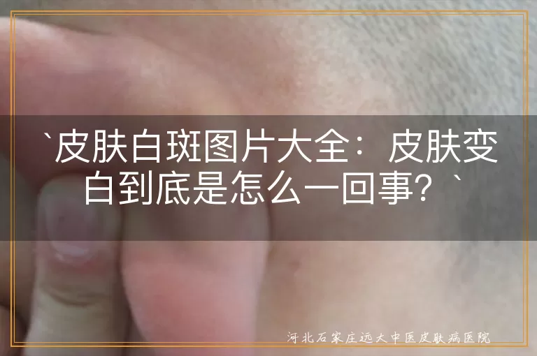 皮肤白斑,白癜风,炎症后色素减退,花斑癣,预防,治疗