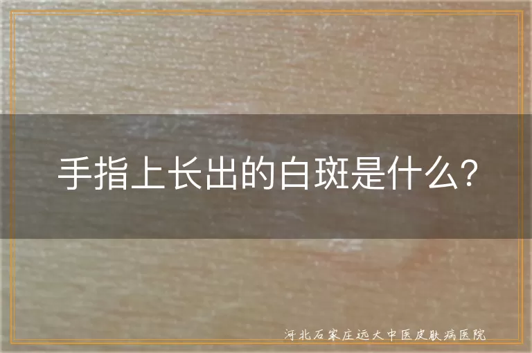 手指白斑,白癜风,贫血痣,白色糠疹,花斑糠疹,营养不良,白色胎记,皮肤老化,就医,对因治疗,日常护理,心理调适