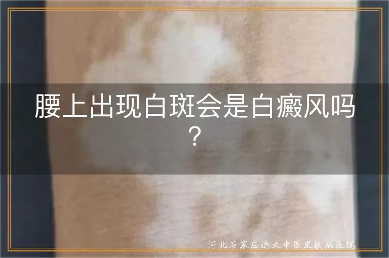 腰上白斑,白癜风,无色素痣,花斑癣,白色糠疹,贫血痣,治疗,预防