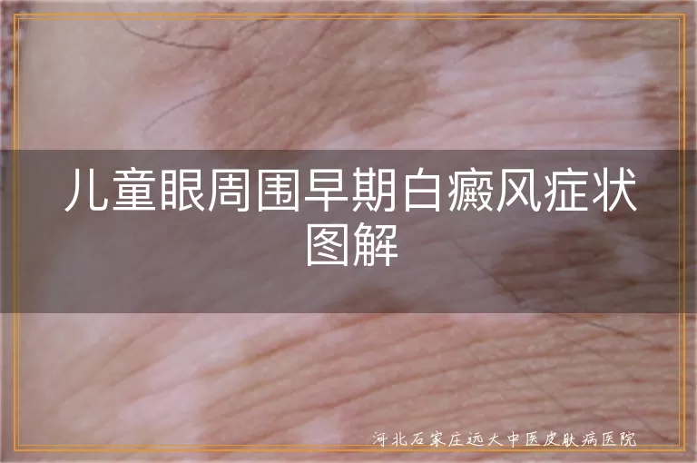 儿童白癜风,眼周围,早期症状,白斑,就医