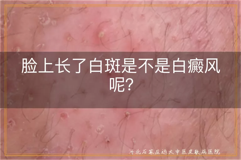 白斑,白癜风,白色糠疹,花斑癣,确诊,治疗,防晒,饮食调整