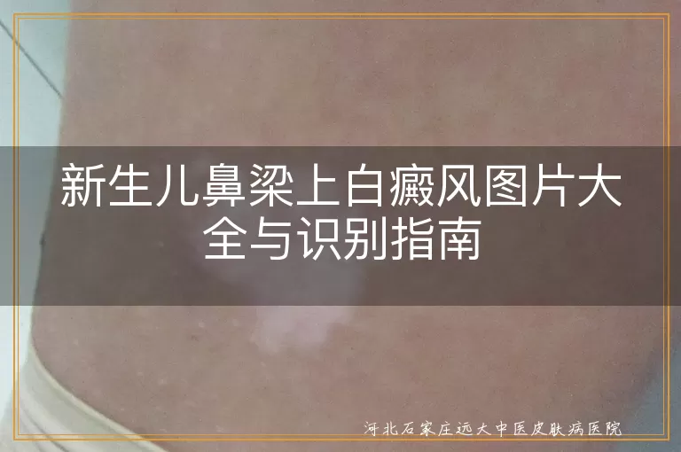 新生儿,鼻梁,白癜风,白斑,识别,治疗,伍德灯,专业检查