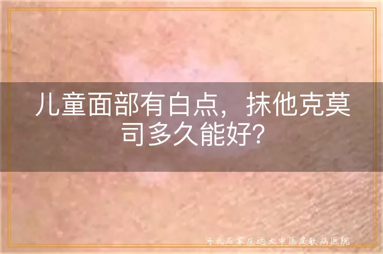 儿童面部白点,他克莫司软膏,白癜风,白色糠疹,治疗时间,注意事项