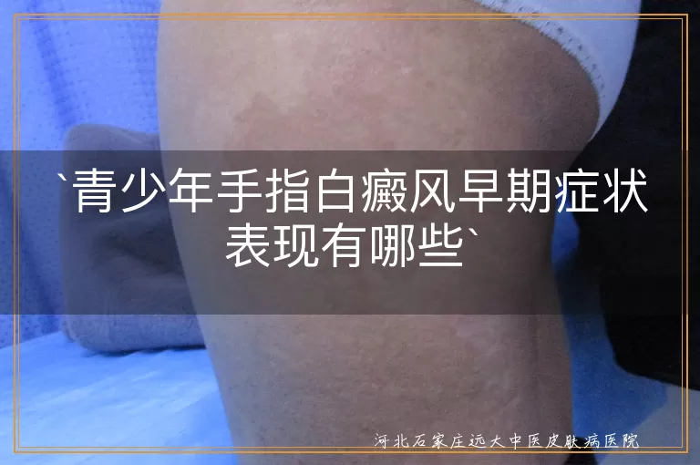 青少年,手指白癜风,早期症状,白斑,光滑,对光敏感,逐渐扩大