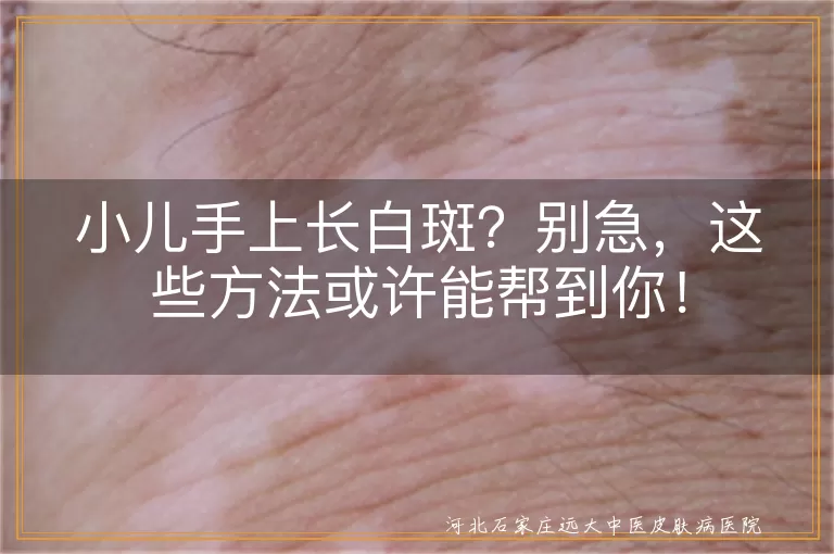 小儿白斑,祛除方法,日常护理,调整饮食,专业治疗,耐心等待