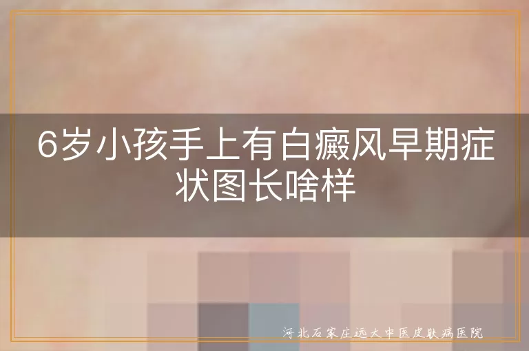 6岁小孩,白癜风,早期症状,白斑,治疗,预防