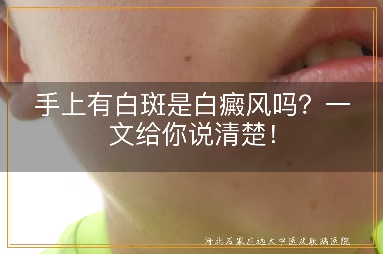 白斑,白癜风,色素脱失,皮肤健康,专业诊断,治疗方法,耐心治疗,生活习惯,饮食健康,乐观心态