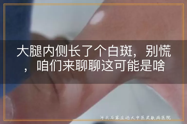 大腿内侧白斑,无色素痣,贫血痣,真菌感染,白癜风,炎症后色素减退,看医生,日常护理