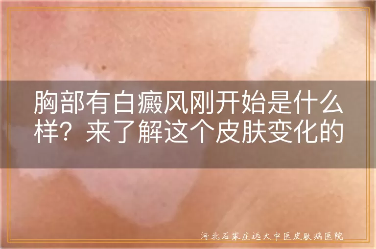 胸部白癜风,初期症状,皮肤色素脱失,遗传,自身免疫,精神压力,环境,专业治疗