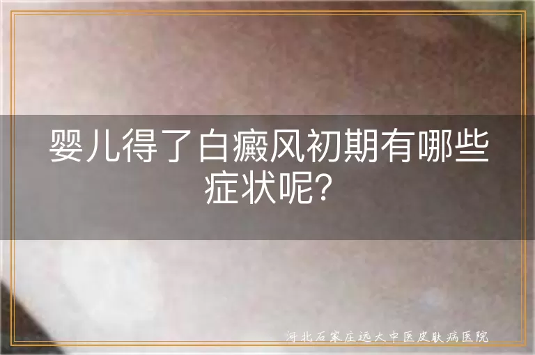 婴儿白癜风,初期症状,白斑,皮肤敏感,情绪变化,日常护理,及时就医