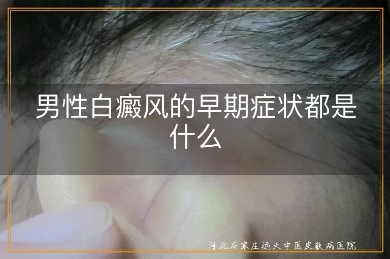 男性白癜风的早期症状都是什么