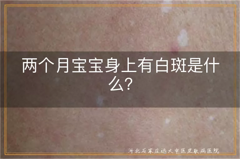 宝宝,白斑,白癜风,白色糠疹,无色素痣,贫血痣,就医,治疗
