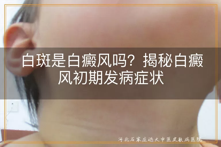 白斑,白癜风,初期症状,边缘清晰,逐渐扩大,对光敏感,毛发变白,及时就医