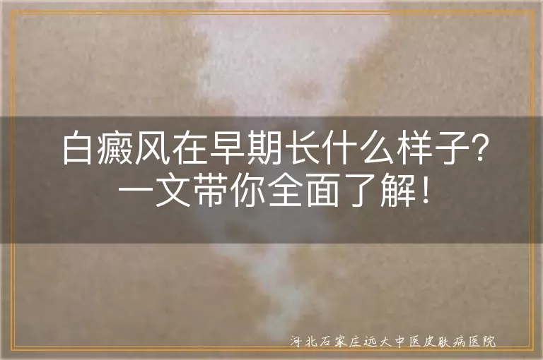 白癜风,早期症状,白斑,边缘模糊,无色素岛,治疗,预防