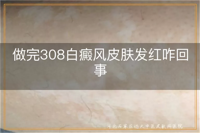 白癜风308激光后皮肤反应,白斑治疗后发红护理,白癜风激光治疗副作用,白斑恢复期间皮肤管理