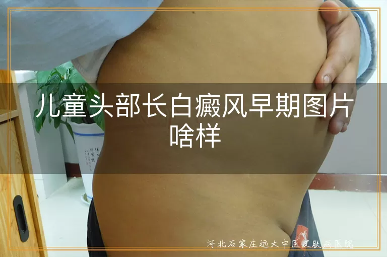 儿童头部白癜风早期症状,白斑形状颜色特点,白癜风扩散情况,专业医生诊断白癜风