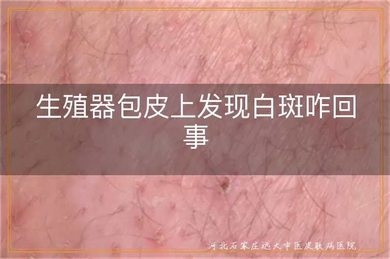 生殖器包皮白斑原因,白癜风症状治疗,白斑护理预防,白斑复发风险