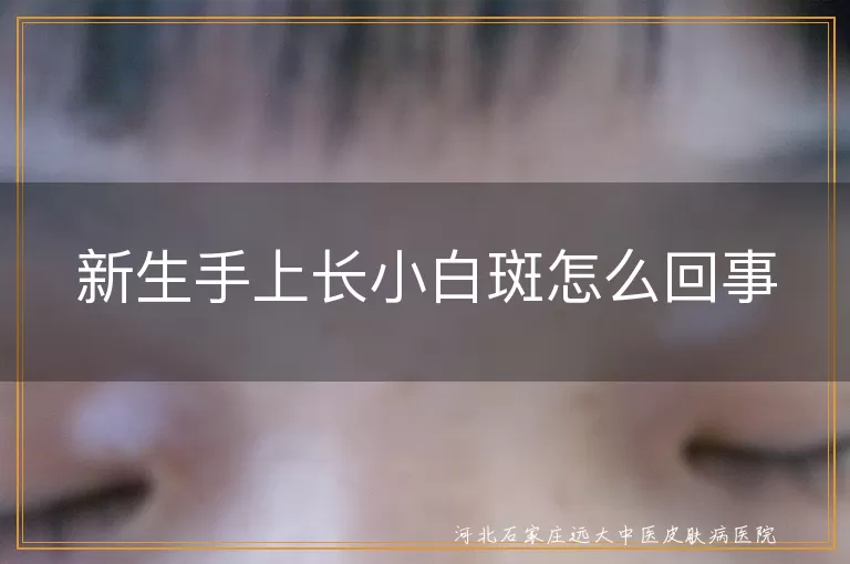 新生儿手上白斑原因, 白癜风症状与治疗, 白斑预防方法, 小儿白斑病