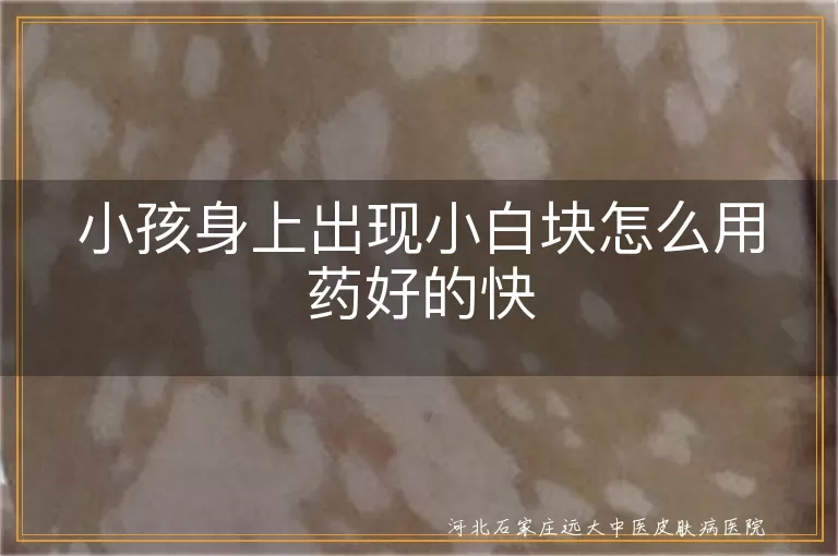 小孩白癜风如何用药,儿童白斑快速治疗方法,白癜风患儿用药指南,儿童白斑药物治疗建议